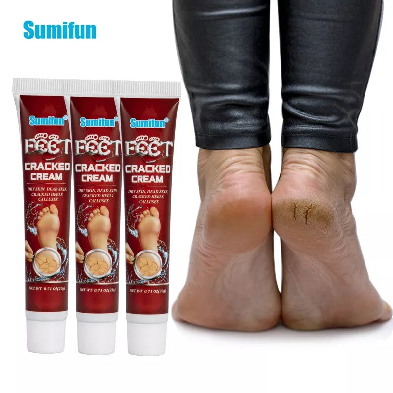 Cracked Hands and Feet Cream | Skin Ointment for Cracked Heels, Dry Skin and Dead Skin
