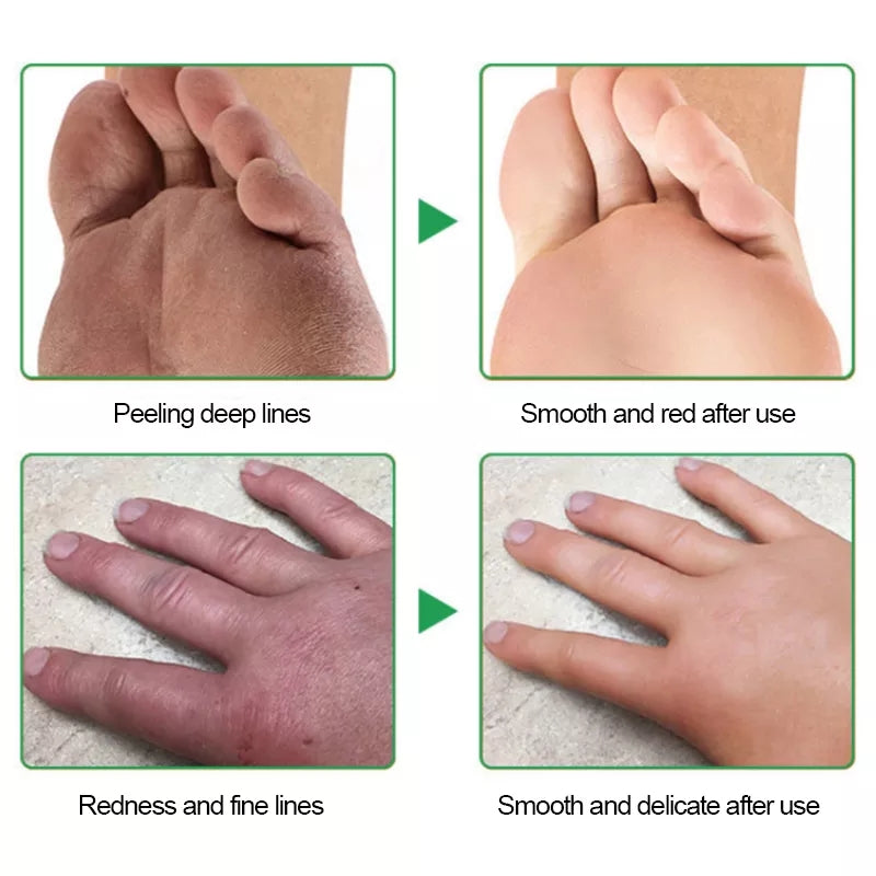 Cracked Hands and Feet Cream | Skin Ointment for Cracked Heels, Dry Skin and Dead Skin