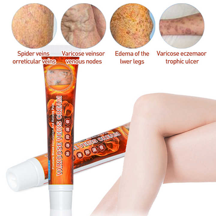 Varicose Veins Cream | Spider Veins Treatment Cream