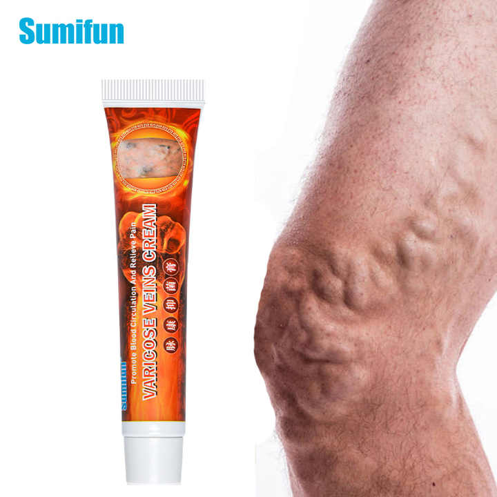 Varicose Veins Cream | Spider Veins Treatment Cream